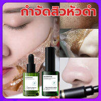 AOPY สูตรอ่อนโยน กำจัดสิวหัวดำ 3 in 1 Set ลบสิวหัวดำและสิว บำรุงกระชับรูขุมขน ขจัดผิวที่ตายแล้ว ผิวกระจ่างใส ครีมลอกสิวเสี้ยน ลอกสิวหัวดำ สิวอุดตัน ลอกได้ทั้งหน้า สูตรใหม่ สำหรับคนเป็นสิว และผิวแพ้ง่าย ( ที่ลอกสิวเสี้ยน ลอกสิวเสี้ยน มาร์คหน้าสิวเสี้ยน)