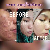 Anti-Acne GEL เจลรักษาสิวทุกชนิด