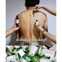 สิวที่หลัง จางหายด้วย Bioscarไบโอสการ์ ลบแผลเป็น
ตุ่ม รอยสิว แผลเป็น น้ำเหลืองไม่ดี ผิวแพ้ง่ายใช้ได้ !!

ปรับผิวขาว เรียบเนียน ลบรอย 
เข่าดำ ศอกดำ คอดำ ต้องใช้
เซรั่มเข้มข้น เห็นผลไว 

หมายเลขใบอนุญาต/อย. 55-1-6500020182
วันหมดอายุ 15/2/2569