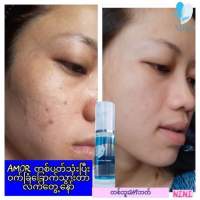 A  mor   Acne Skin Clean