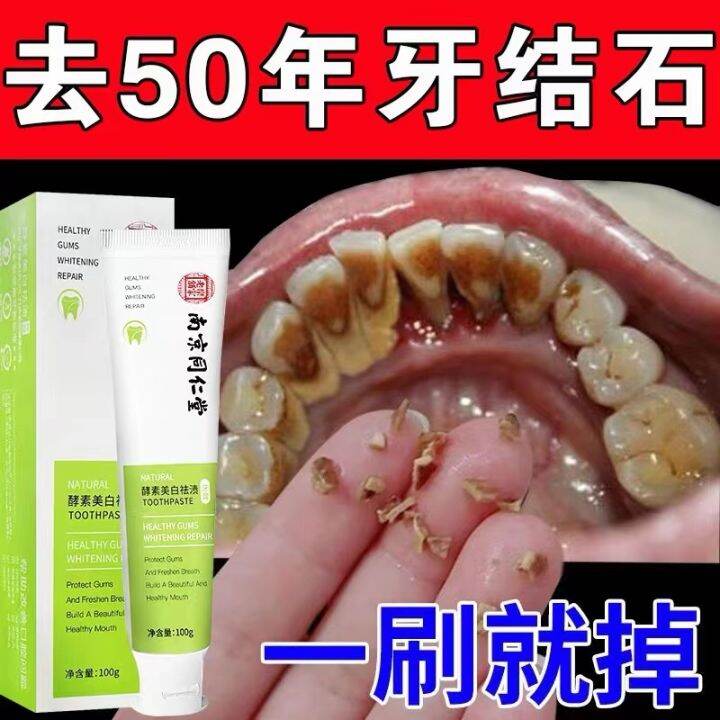 Remove Dental Stones in Seconds, Dissolve Dental Stones, Smoke Stains