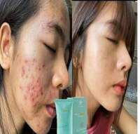 IAura Gel &amp; Suncream??

? ဝက္ၿခံ ေတြခ်ပ္ေစတယ္
? အမာရြတ္ပါေပ်ာက္တယ္
? အဆီဖုဆို ေပ်ာက္တာပိုျမန္ပါတယ္
? အမဲစက္ေတြ ပါးေစပါတယ္
? မွဲ႕ေျခာက္ ေပ်ာက္ပါတယ္
? တင္းတိပ္ေတြ ပါးေစပါတယ္ 

၂ပတ္ေလာက္နဲ႔ သိသာလာၿပီးအသားရည္ညီလာတယ္ျဖဴလာတယ္မ်က္ႏွာေလးကိုၾကည္လင္ေစပါတယ္