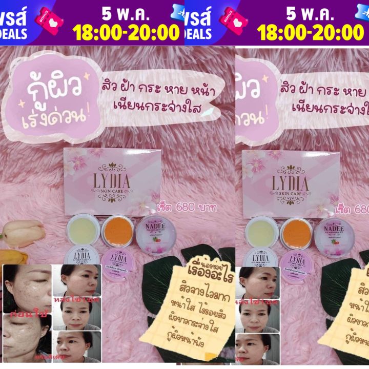 ของแท้-ลีเดียครีมหน้า-1ชุดมา-2ตลับ-จ้ะ-อย่าให้สิว-เป็นปัญหาบนใบหน้าอีกต่อไป-เร่งดูแลก่อนจิพังมากไปกว่านี้-ลิเดียของแท้