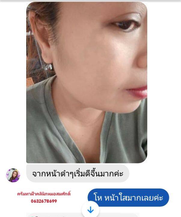 ส่งฟรี-คู่ครีมรักษาฝ้า-หน้าเด็ก-คลินิกหมอสมศักดิ์-นายแพทย์สมศักดิ์-คุณจักร