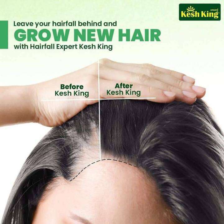 kesh-king-anti-hair-fall-herbal-shampoo-india-ของแท้-ฉลากไทย-แชมพู-ลดผมร่วง-เพิ่มผม-ลดรังแค-ขจัดปัญหาเส้นผม-จากอินเดีย