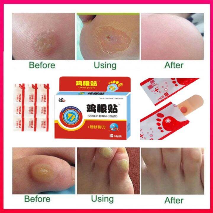 [Malaysia Warehouse]Corn Removal Plaster Feet Corns Wart Stickers Foot