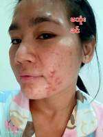 ဒီတစ်စုံရဲ့အစွမ်းလေး တကယ်သုံးဖူးတဲ့သူတိုင်းမှသိမှာပါ အချိန်မပေးပဲသုံးနေရင်အလကားပဲဖြစ်သွားမယ်
ဒါကြောင့်နေတိုင်းညတိုင်းအဆက်မပျက်သုံးသွားပါ ကိုယ်လိုချင်တဲ့မျက်နာလေးပြန်ရစေရမယ်ရှင့်

#IAURA