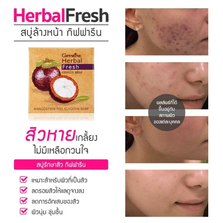 สบู่ล้างหน้า-กิฟฟารีน-ผสมเปลือกมังคุด-รักษาสิว-ฝ้า-หน้าขาวกระจ่างใส-herbal-fresh-mangosteen-glycerin-soap