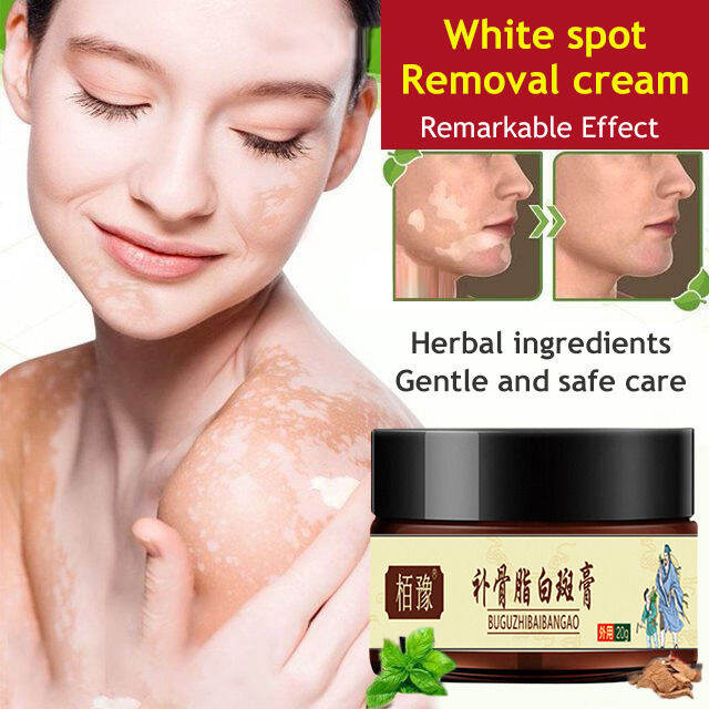 Vitiligo Treatment Cream 20G Natural Chinese Herb Herbal White spots