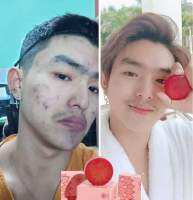 #မျက်နှာအသားရေကောင်းဖို့မျက်နှာသစ်ဆေးကလည်းအရေးကြီးတယ်နော်?
မျက်နှာမာလည်း အမဲစက်တွေနဲ့ ဆား၀က်ခြံတွေကလည်းဖွေးနေရင် ဝက်ခြံတွေကလည်း ပေါက်နေရင်တော့ Lana Soap လေးနဲ့ စမ်းသစ်ကြည့်နော်?
14ရက်အတွင်းသိသိသာသာပြောင်းလဲသွားပါလိမ့်မယ်?