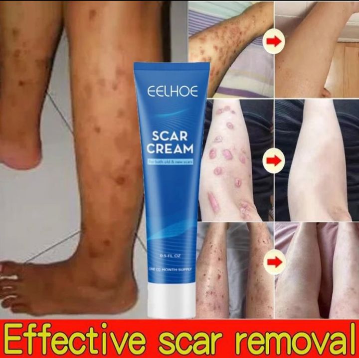 Scar Removal Cream Membantu Menghilangkan Bekas Luka Dan Memperbaiki