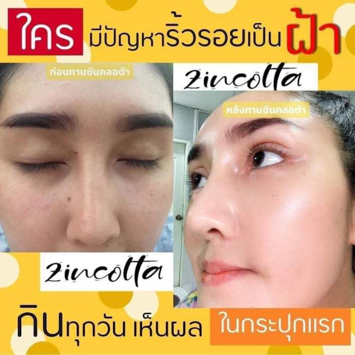 ซินคลอต้า-zincolta-น้ำมันอะโวคาโด้สกัดเย็นผสมคอลลาเจนเข้มข้น-แก้ปัญหาผิวได้ดีสุดจากภายในสู่ภายนอก-ของแท้ส่งฟรี