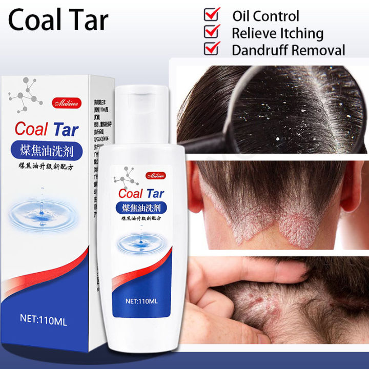 coal tar shampoo anti dandruff shampoo kelemumur scalp care seborrheic dermatitis antiitch oil