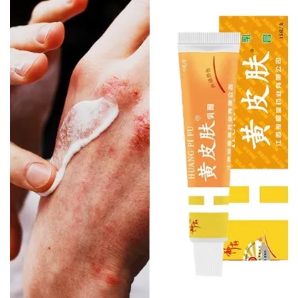 Eczema Cream 15g Chinese medicine ointment eczema antibacterial itchy ...