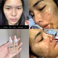 Jellymask Serum ကဲမျက်နာ တင်းတိတ် အမဲစက် သမားများအတွက်နော် CANA SERUM ‌ေစလန်းလေး