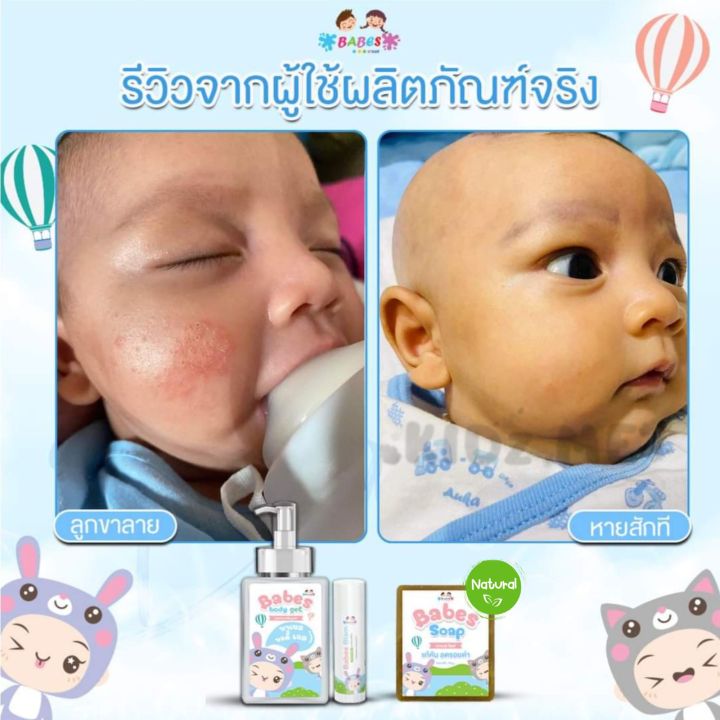 babes-soap-บาเบส-โซฟ-สบู่แก้คัน-ขาลาย-แพ้ยุง