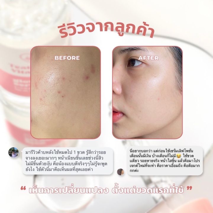 เซรั่มเลิฟจิ๋วสูตรพรีเมี่ยม-10ml-ลดผิวเหมาะกับผิวแพ้ง่าย-ลดสิวได้ทุกรูปแบบ-เพิ่มความนุ่มเด้งเรียบเนียนให้กับผิว