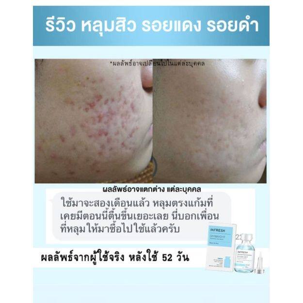 infresh-เซรั่มหลุมสิว-หลุมสิว-รูขุมขนกว้าง-สูตรเร่งรัด-สารสกัดจากธรรมชาติ-ผ่านการวิจัย-muco-เซรั่มแก้ปัญหาหลุมสิว-ลดรอยแดง-ลดรอย-ปรับให้ผิวกระจ่างใส-รูขุมขนกระชับ-ขนาด-30-มล