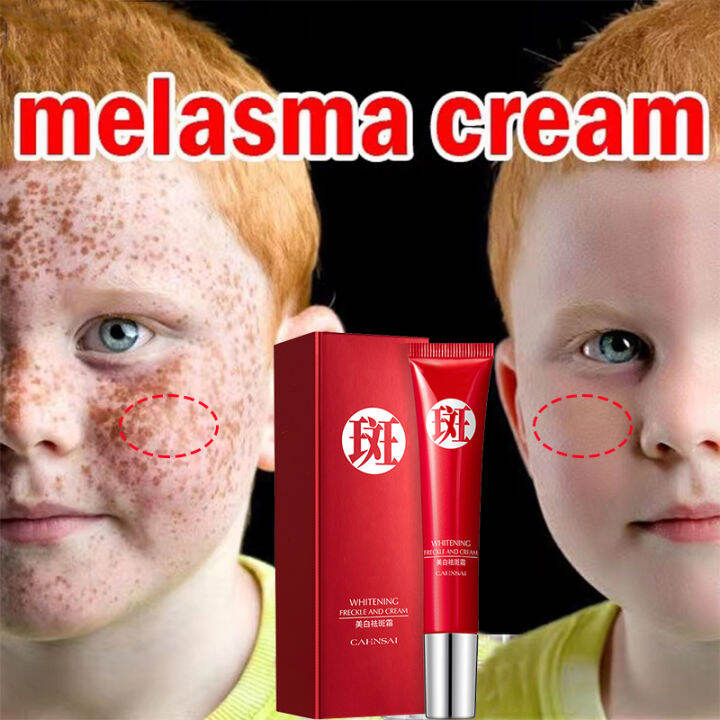 Melasma Cream Pekas Remover Whitening Freckle Cream Japanese Melasma