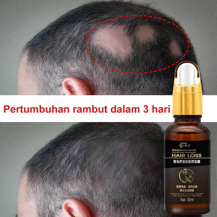 Penumbuh Rambut Botak Wanita Penumbuh Rambut Cepat Dan Tebal Anti Hair ...