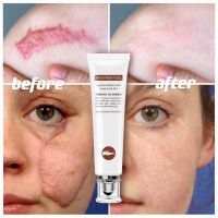 VG repair scar gel remove acne scar burns cuts operation mark เจลลดรอยแผลเป็นสำหรับผิวหน้าลบรอยแผลเป็น เจลลดรอยแผลเป็น 20g