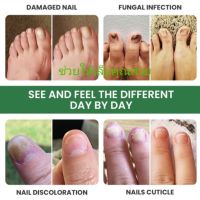 Eelhoe nail fungus น้ำยาบำรุงเล็บจำกัดเชื้อราที่เล็บ เล็บขบ เล็บปวด เชื้อราที่เล็บ