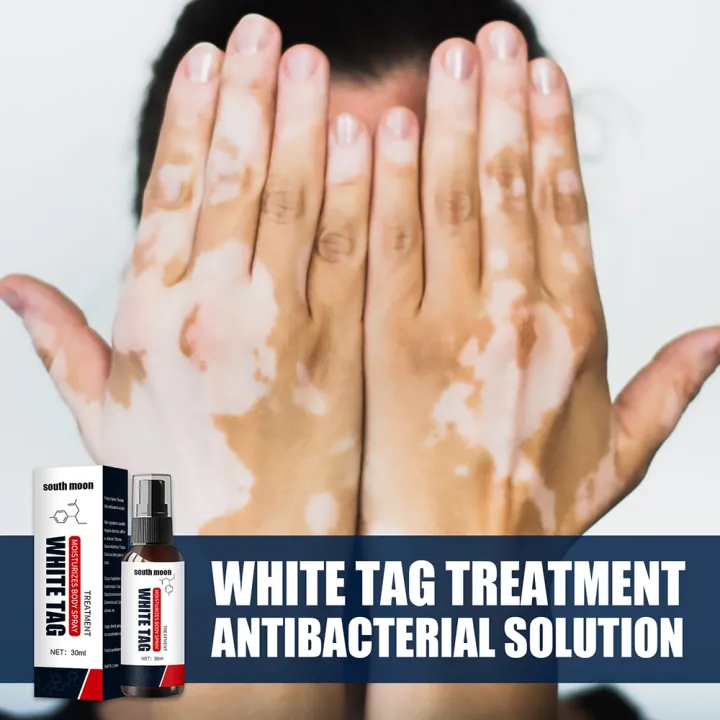 Vitiligo Spray Repair White Spot Vitiligo Cream Pigment Melanin Repair Vitiligo Spray Repair White Spot Vitiligo Cream Pigment Melanin Repair