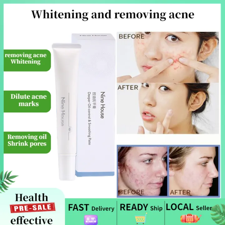 Anti Acne facial wash pimple remover Face whitening Acne closed mouth