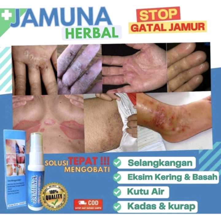 Obat Eksim Kering Dan Basah Gatal Selangkangan Skabies Kudis Dan Jamur