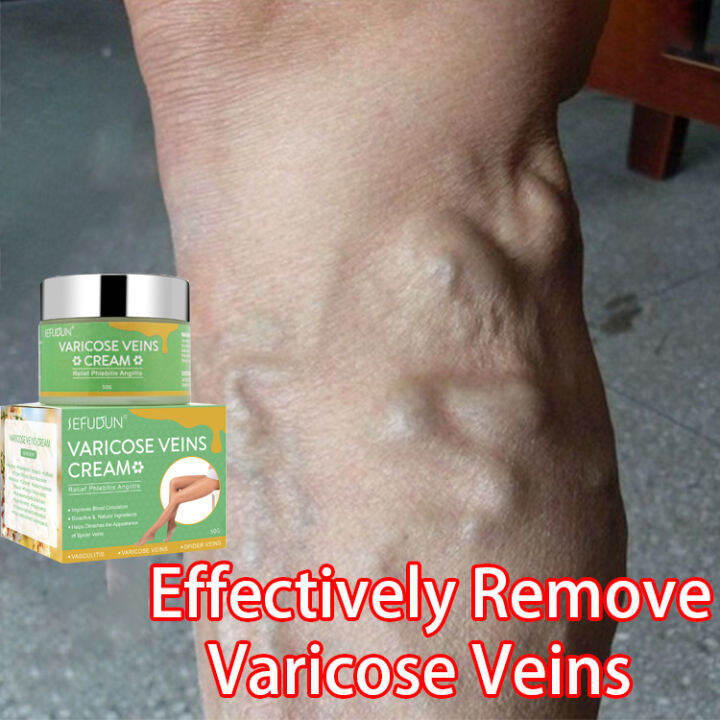 Original SEFUDUN Varicose Veins Remover Effective Original for Varicose ...