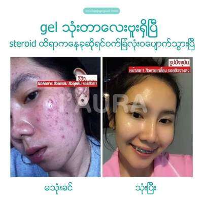 IAura ME-Sunscreen +College Gel ဝက်ခြံအမဲစက်သက်သာစေတယ်