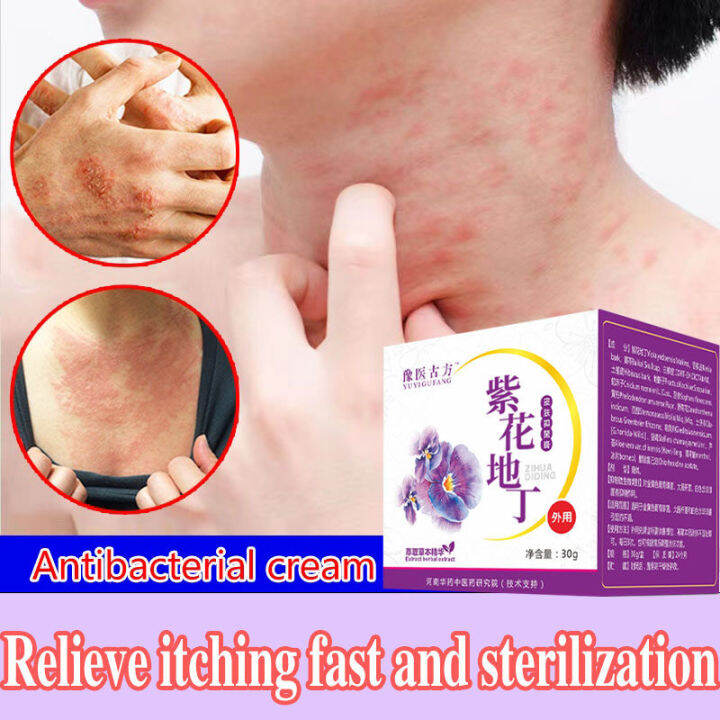 Psoriasis Ointment Eczema treatment cream antifungal and antipruritic