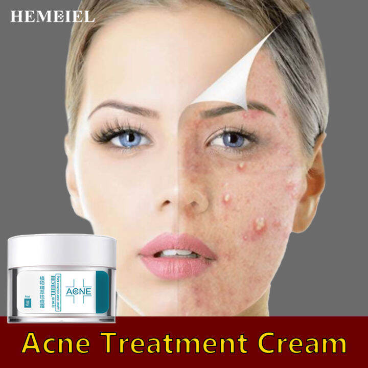 HEMEIEL Acne Treatment Cream Anti Acne Face Cream Pimple Removal Spots