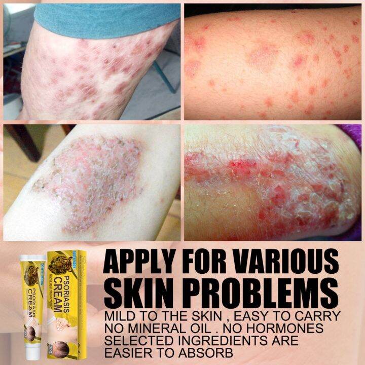 Eczema Psoriasis Hand And Foot Psoriasis Cream Ringworm Sweating Herpes