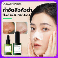 AOPY สูตรอ่อนโยน กำจัดสิวหัวดำ 3 in 1 Set ลบสิวหัวดำและสิว ขจัดผิวที่ตายแล้ว สำหรับคนเป็นสิว บำรุงกระชับรูขุมขน ผิวกระจ่างใส สิวอุดตัน ลอกได้ทั้งหน้า สูตรใหม่ ครีมลอกสิวเสี้ยน ลอกสิวหัวดำ และผิวแพ้ง่าย ( ที่ลอกสิวเสี้ยน มาร์คหน้าสิวเสี้ยน ลอกสิวเสี้ยน)