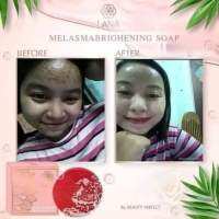 ဝက်ခြံပျောက်တ့ဲ မျက်နှာသစ် Lana Soap