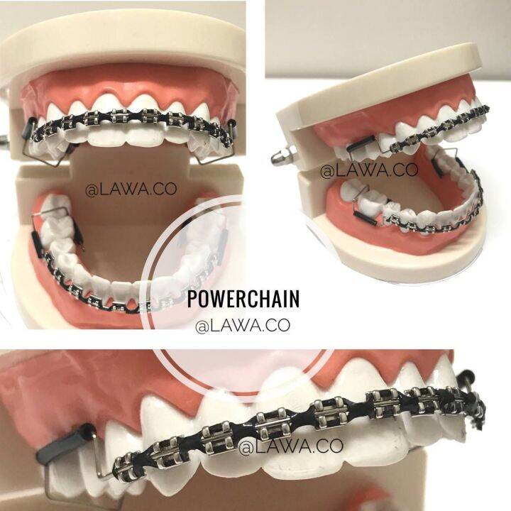 Braces Click Powerchain (Black color) one pair Upper & Lower Pendakap