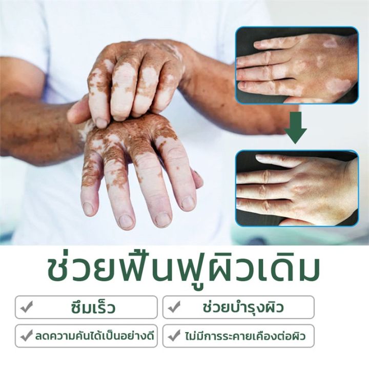 7วัน-เห็นผล-south-moon-ครีมทาด่างขาว-20g-สารสกัดจากสมุนไพร-ไม่ระคายเคือง-ใช้ได้ทั้งร่างและทุกวัย-ผลิตภัณฑ์กระตุ้นการสร้างเม็ดสีของผิว-โรคด่างขาว-โรคผิวหนัง-ผลิตภัณฑ์-vitiligo-ด่างขาวที่หน้า-ด่างขาวที่