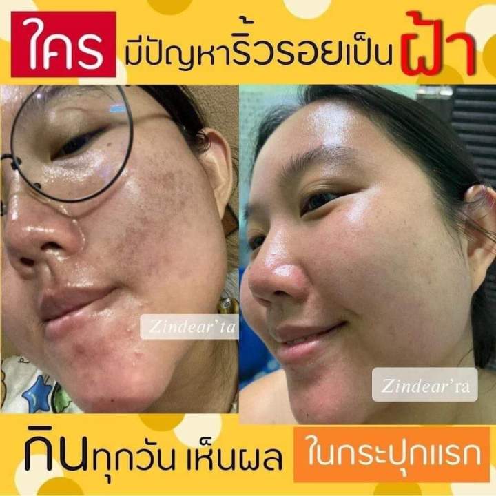 ซินคลอต้า-zincolta-น้ำมันอะโวคาโด้สกัดเย็นผสมคอลลาเจนเข้มข้น-แก้ปัญหาผิวได้ดีสุดจากภายในสู่ภายนอก-ของแท้ส่งฟรี