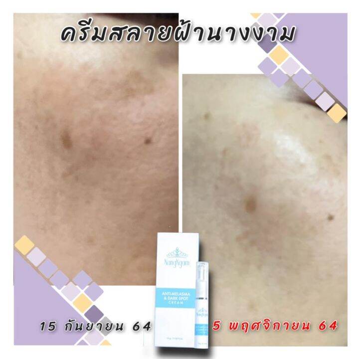 เซรั่มฝ้า-นางงาม-ทาฝ้า-กระ-จุดด่างดำ-anti-melasma-amp-dark-spot-cream-3-หลอด