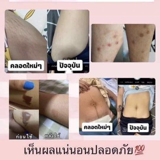 ศิริราชซอฟท์แคร์พลัส-ครีมบำรุงผิวแห้งกร้าน-แตกลาย-มีปัญหาเข่าศอกดำด้าน