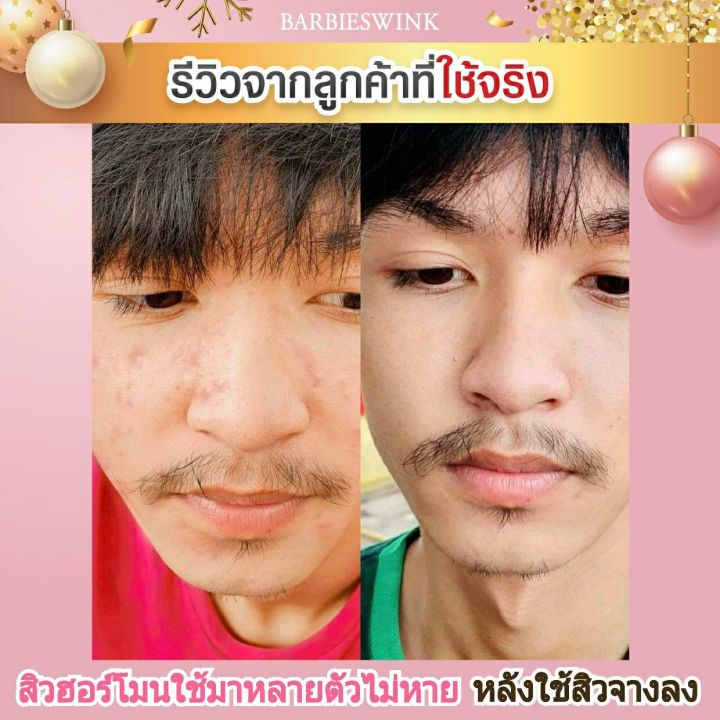 สบู่แพลงก์ตอนบาร์บี้วิ้งค์-ลดสิว-รอยสิว-ฝ้ากระ-จุดด่างดำจาง-รูขุมขนกระชับ