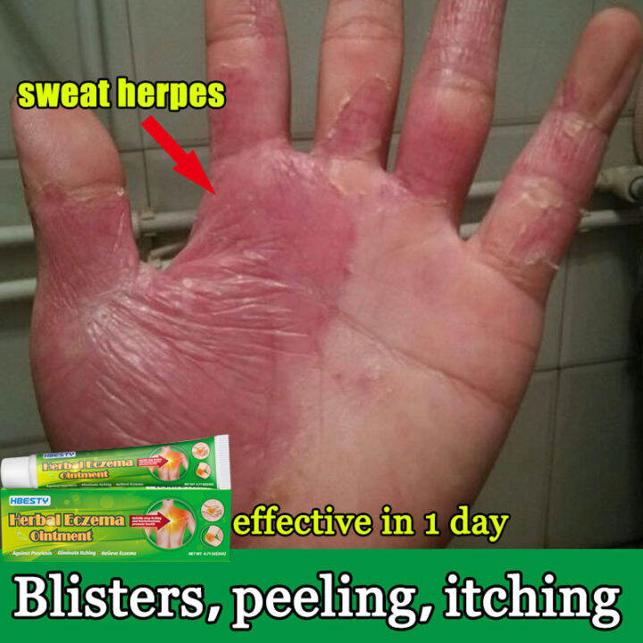 Original And Effective Eczema Treatment Herbal Antibacterial Cream 20g