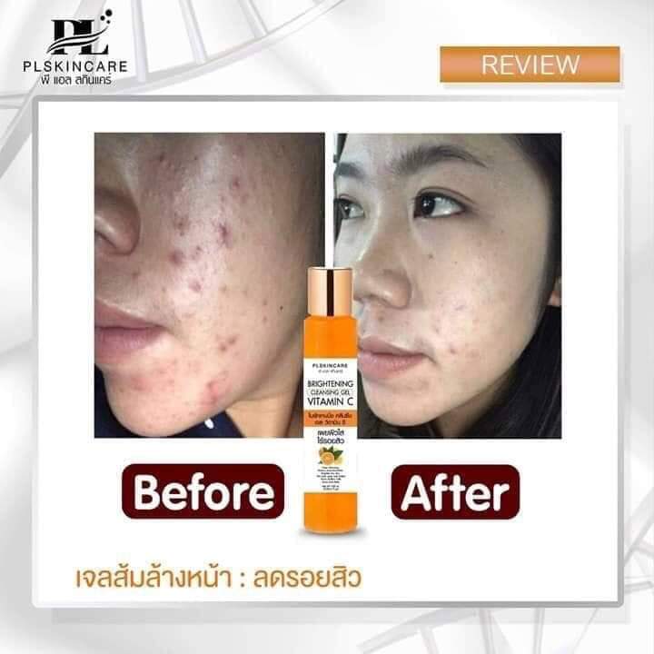 cleansing-gel-vitamin-c-เจลส้ม-สบู่ล้างหน้าลดรอยสิว-ลดจุดด่างดำ-เพิ่มความกระจ่างใส