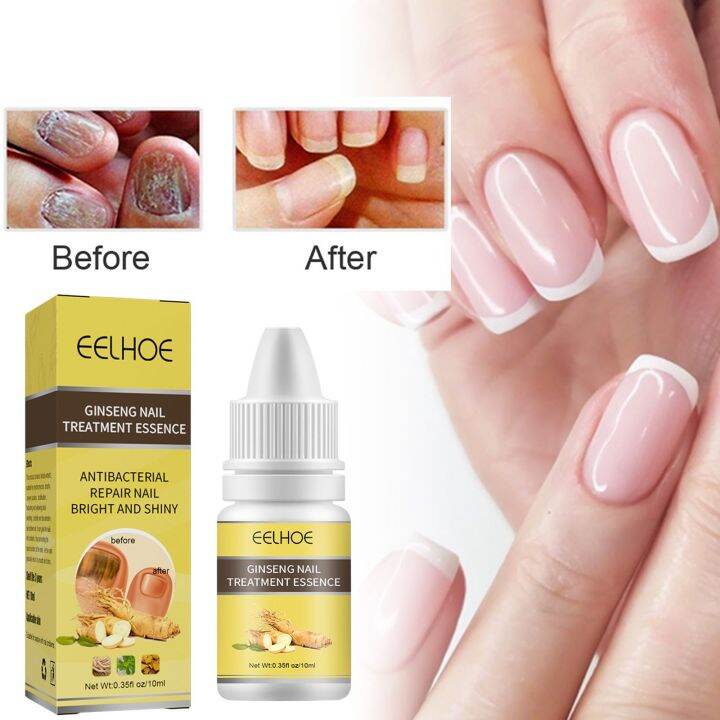 EFERO Nail Fungus Serum Antifungal Nail Serum Nail Fungus Removal Toe Moisturizing and Shining