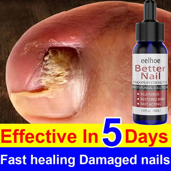 【100 Effective in 5 days】Eelhoe Nail repair treatment cream Nail