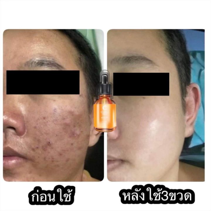 serum-vit-c-2-ขวด-450-บาท-ส่งฟรี-แถมฟรี-สบู่ส้ม-2-ก้อน-มีเก็บปลายทาง