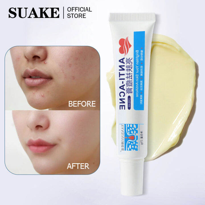 SUAKE Remove Pimples Quickly Pimple Remover Acne Cream Fades Acne Marks