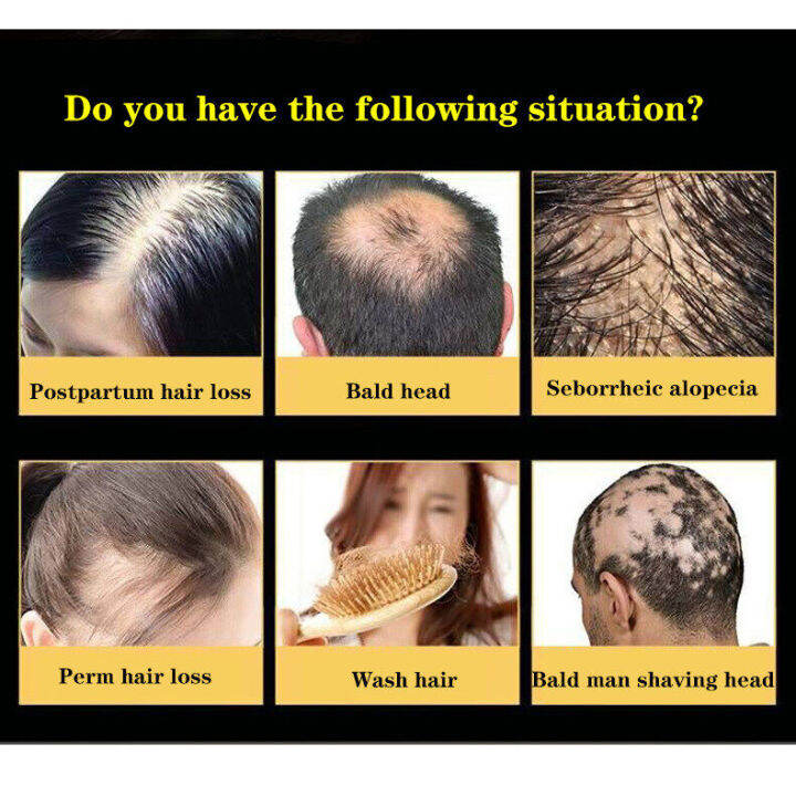 Ginger Juice Hair Growth Shampoo Man & Woman Bald Regrowth Hair Relieve Itchy Scalp Dandruff Anti Hair Dense Hair Growth Healthy Nourishing Hair Roots Shampoo | Lazada Ginger Juice Hair Growth Shampoo Man & Woman Bald Regrowth Hair Relieve Itchy Scalp Dandruff Anti Hair Dense Hair Growth Healthy Nourishing Hair Roots Shampoo | Lazada