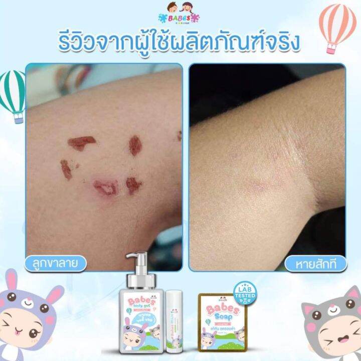 babes-body-gel-บาเบส-บอดี้-เจล-โลชั่นฟื้นฟูผิว-ลดรอยดำ-รอยแดง